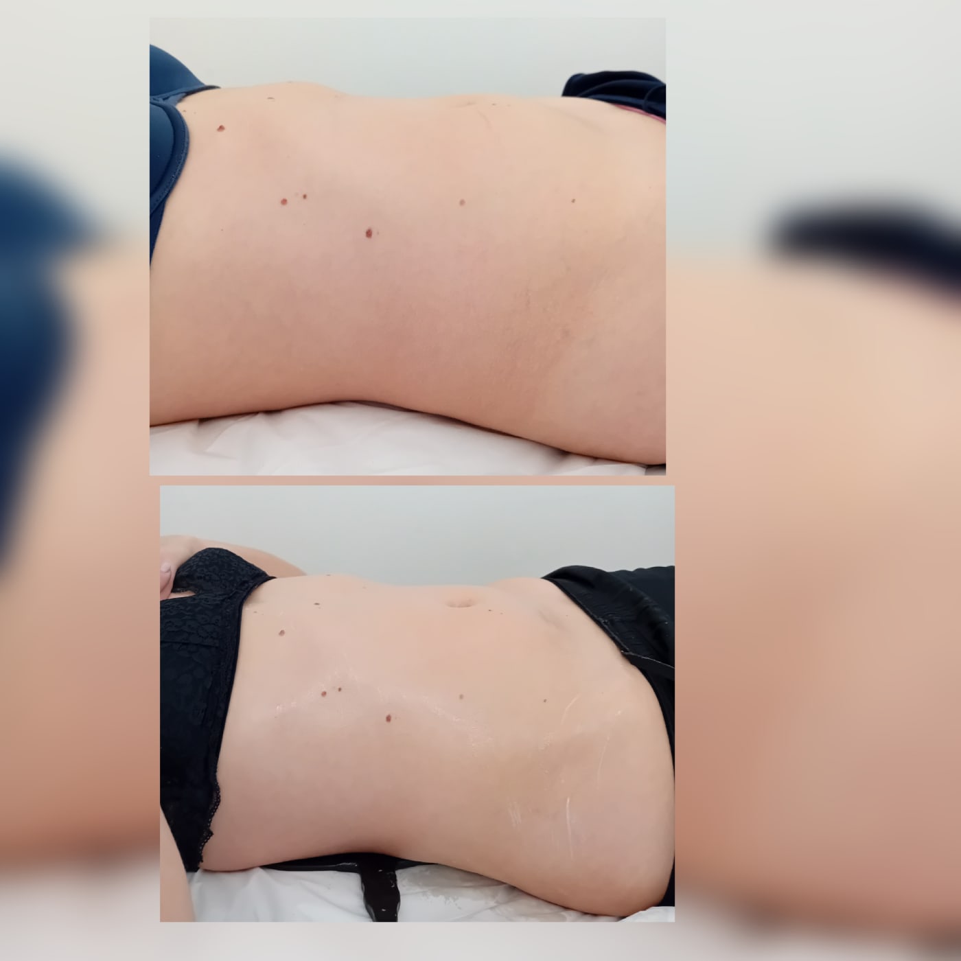 Tratamento corporal de radiofrequência na Mais Estética em Lagos